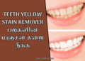 Teeth Yellow Stain Remover | பற்களின் மஞ்சள் கறை நீக்க