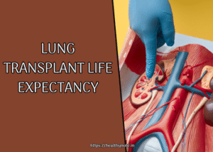 Lung Transplant Life Expectancy What You Need to Know to Prepare for the Future