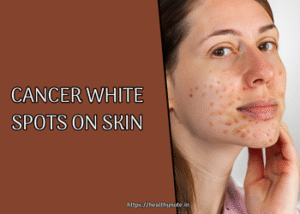 Cancer White Spots on Skin