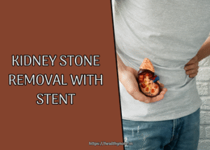 Kidney Stone Removal with Stent