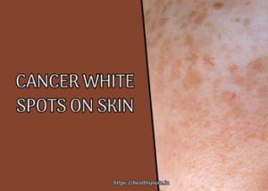 Cancer White Spots on Skin
