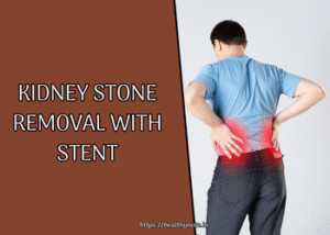 Kidney Stone Removal with Stent