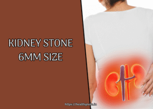 Kidney Stone 6mm Size