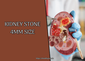 Kidney Stone 4mm Size