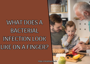 What Does a Bacterial Infection Look Like on a Finger?