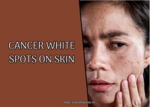 Cancer White Spots on Skin