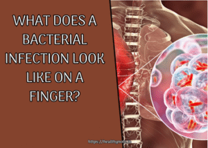 What Does a Bacterial Infection Look Like on a Finger?