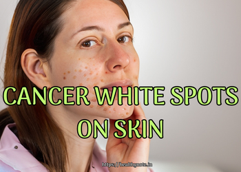 Cancer White Spots on Skin