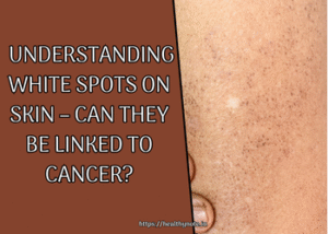 Understanding White Spots on Skin – Can They Be Linked to Cancer