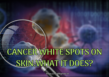 Cancer White Spots on Skin.What it does